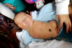 'Sọ Dừa' bé bỏng được chào đời